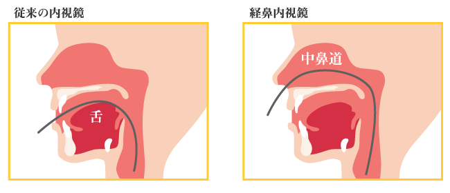 経鼻内視鏡のメリット